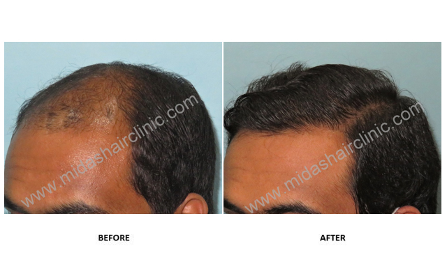 Before and After Hair Transplant Results in Bangalore India