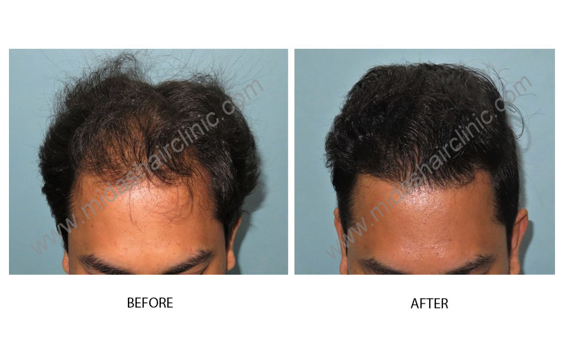 FUE Hair Transplant in Bangalore | Hair Transplant in Bangalore | Best Hair  Transplant in Bangalore | Cost of FUE hair transplant in Bangalore | Best clinic  Hair Transplant in Bangalore |