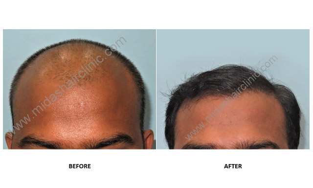 FUE Hair Transplant in Bangalore | Hair Transplant in Bangalore | Best Hair  Transplant in Bangalore | Cost of FUE hair transplant in Bangalore | Best  clinic Hair Transplant in Bangalore |