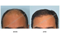 Hair Restoration
