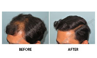 Hair Restoration