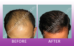 Midas Hair Clinic - HairTransplant, Hair Regrowth, Hair Medical Treatments, Hair  Loss Treatments